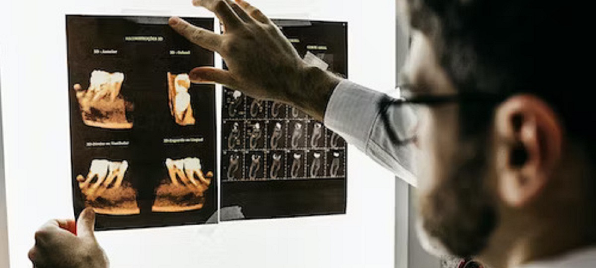 High-resolution X-ray image displaying dental cavities in the teeth of a patient