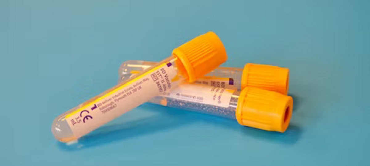 A healthcare professional analyzing a blood sample for autoimmune disease markers in a laboratory setting.