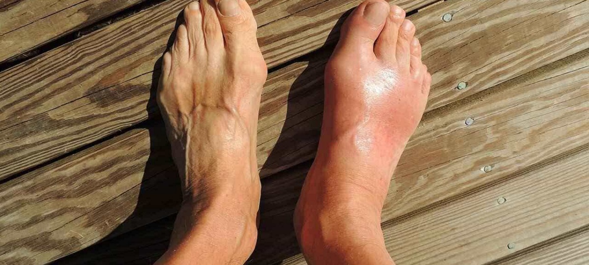 Illustration depicting the symptoms of gout, including a swollen, red, and tender joint.